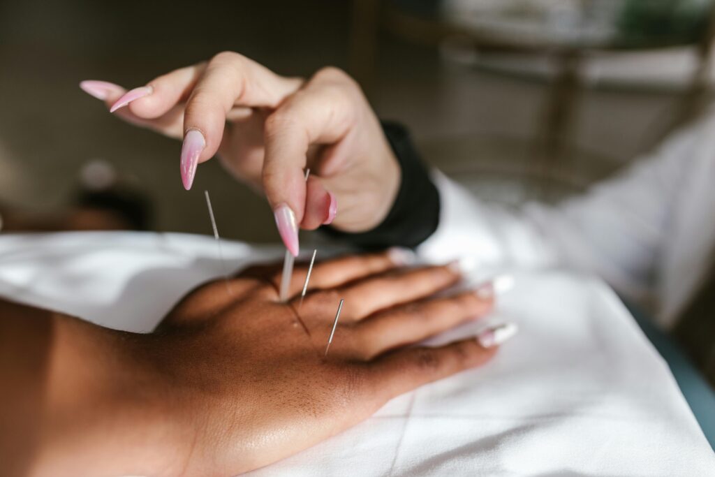 A detailed view of an acupuncture session for holistic health and wellness.